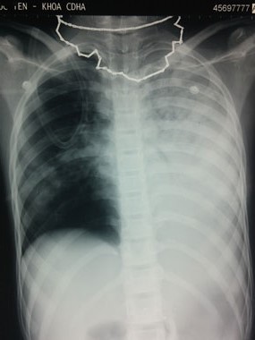 Hình ảnh phổi tổn thương của bệnh nhi. Ảnh: BV cung cấp